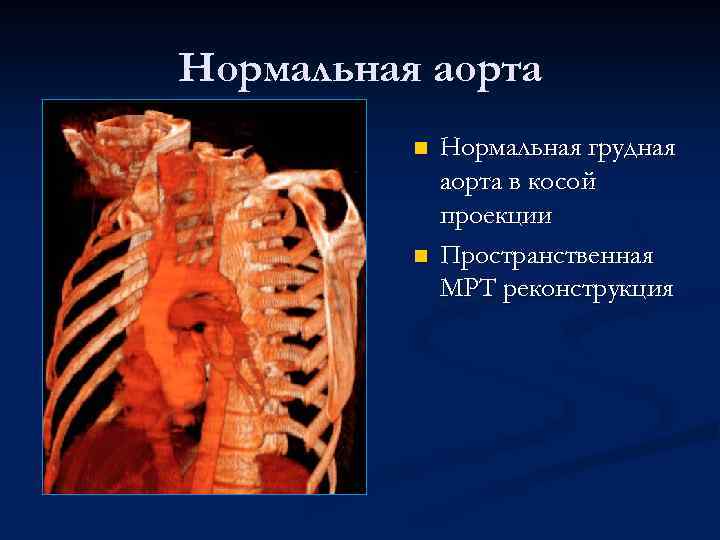 Нормальная аорта n n Нормальная грудная аорта в косой проекции Пространственная МРТ реконструкция 