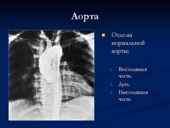 Аорта n Отделы нормальной аорты: 1. 2. 3. Восходящая часть. Дуга. Нисходящая часть 