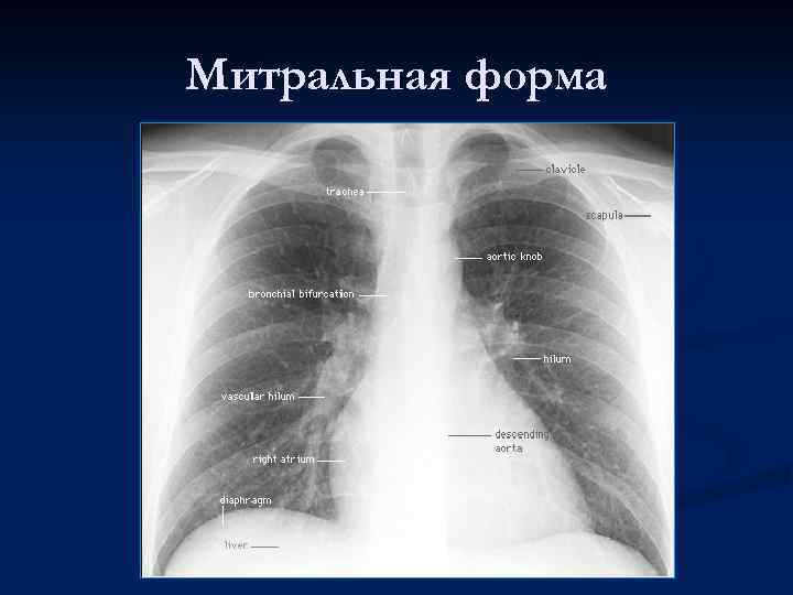 Митральная форма 