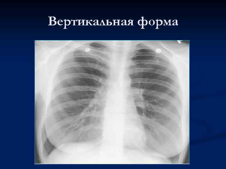 Вертикальная форма 