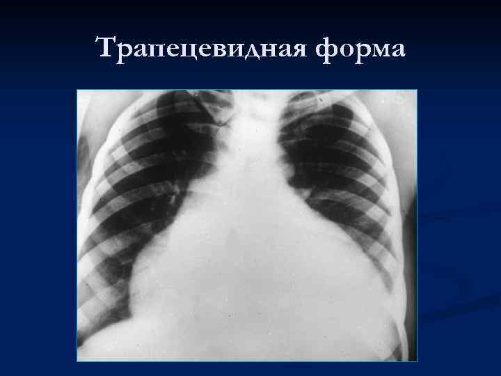 Трапецевидная форма 