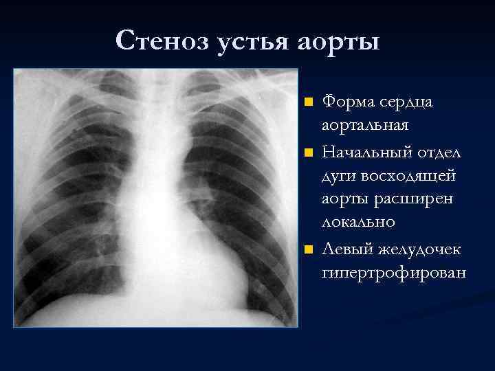 Стеноз устья аорты n n n Форма сердца аортальная Начальный отдел дуги восходящей аорты