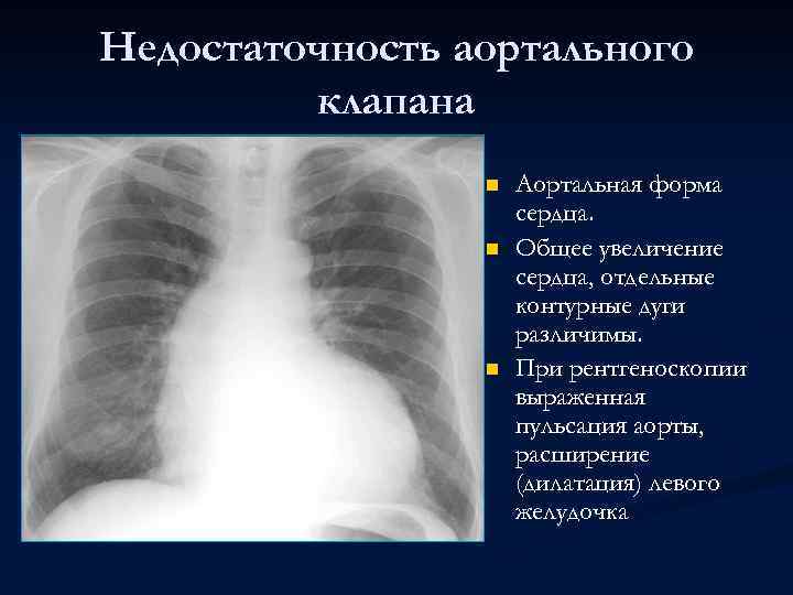 Недостаточность аортального клапана n n n Аортальная форма сердца. Общее увеличение сердца, отдельные контурные