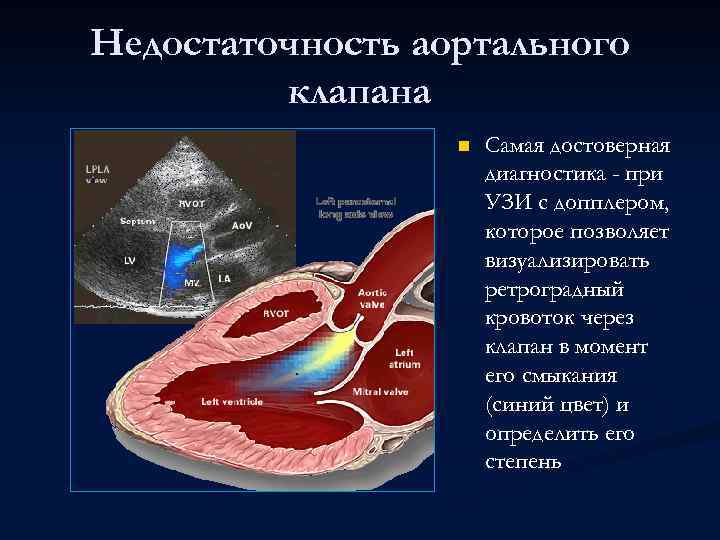 Недостаточность аортального клапана n Самая достоверная диагностика - при УЗИ с допплером, которое позволяет