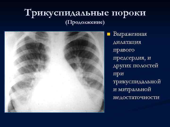 Трикуспидальные пороки (Продолжение) n Выраженная дилатация правого предсердия, и других полостей при трикуспидальной и