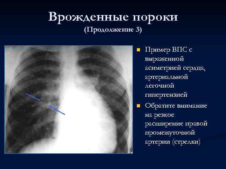 Врожденные пороки (Продолжение 3) n n Пример ВПС с выраженной асиметрией сердца, артериальной легочной