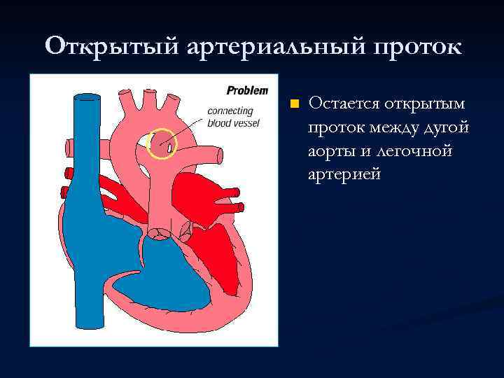 Открытый артериальный проток n Остается открытым проток между дугой аорты и легочной артерией 