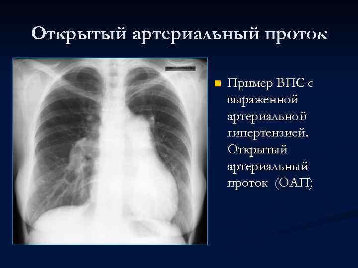 Открытый артериальный проток n Пример ВПС с выраженной артериальной гипертензией. Открытый артериальный проток (ОАП)