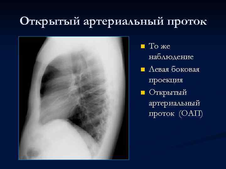 Открытый артериальный проток n n n То же наблюдение Левая боковая проекция Открытый артериальный