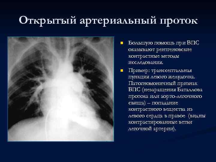 Открытый артериальный проток n n Большую помощь при ВПС оказывают рентгеновские контрастные методы исследования.