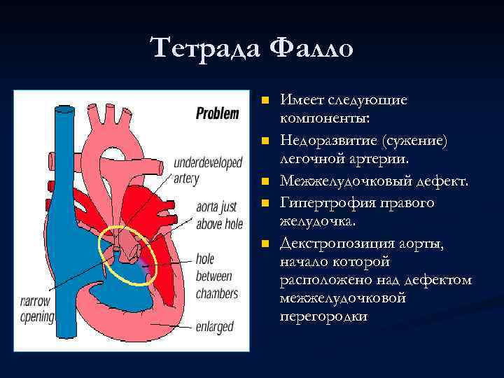 Тетрада Фалло n n n Имеет следующие компоненты: Недоразвитие (сужение) легочной артерии. Межжелудочковый дефект.