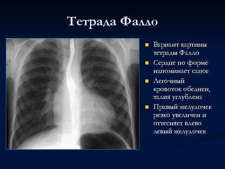 Тетрада Фалло n n Вариант картины тетрады Фалло Сердце по форме напоминает сапог Легочный