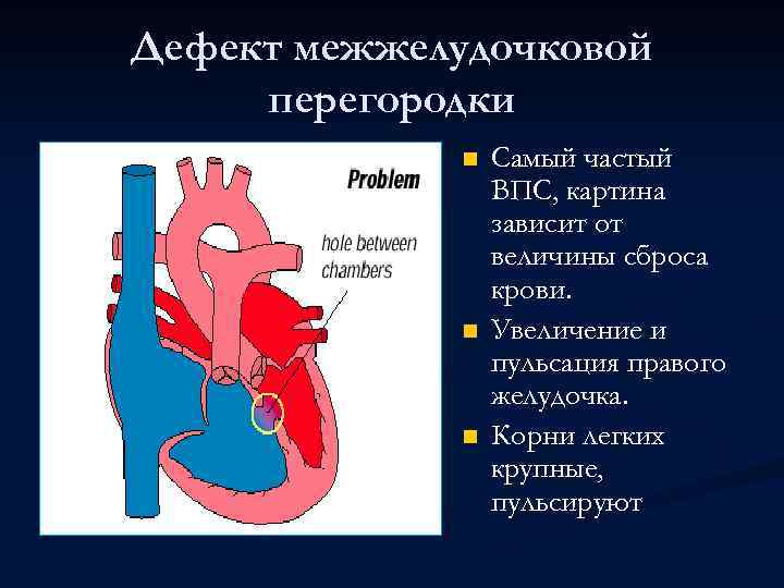 Дефект межжелудочковой перегородки n n n Самый частый ВПС, картина зависит от величины сброса