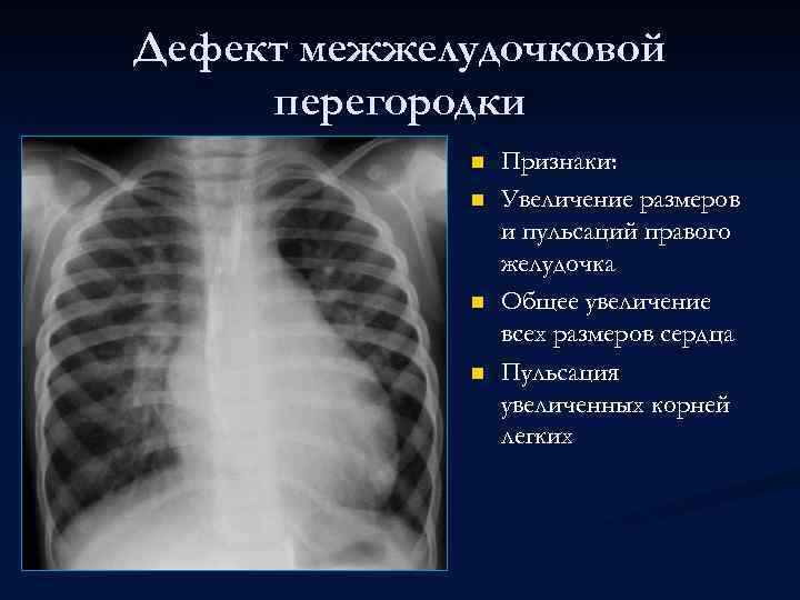 Дефект межжелудочковой перегородки n n Признаки: Увеличение размеров и пульсаций правого желудочка Общее увеличение