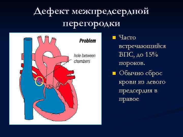 Дефект межпредсердной перегородки n n Часто встречающийся ВПС, до 15% пороков. Обычно сброс крови