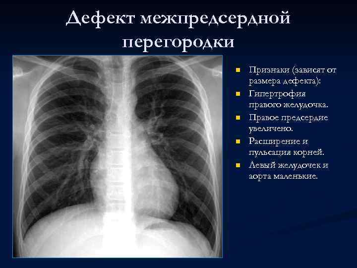 Дефект межпредсердной перегородки n n n Признаки (зависят от размера дефекта): Гипертрофия правого желудочка.