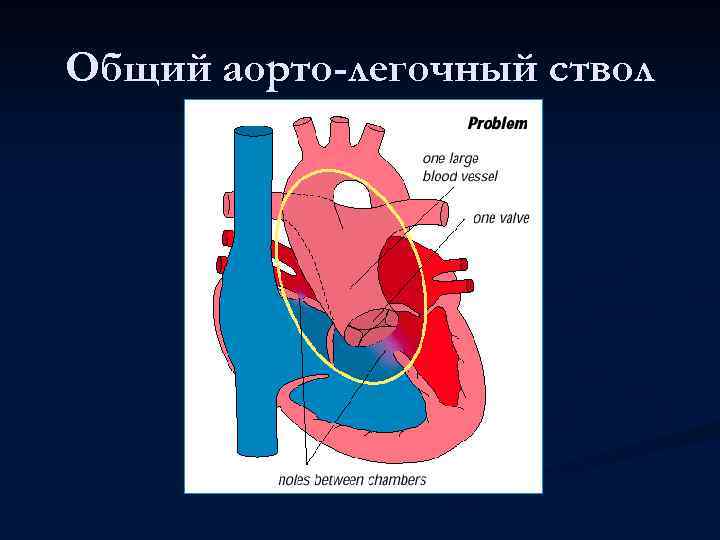 Общий аорто-легочный ствол 