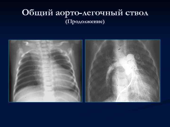 Общий аорто-легочный ствол (Продолжение) 