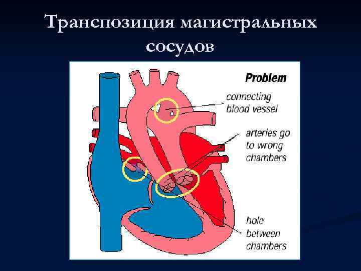 Транспозиция магистральных сосудов 