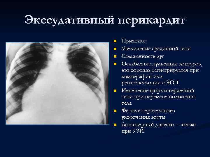 Экссудативный перикардит n n n n Признаки: Увеличение срединной тени Сглаженность дуг Ослабление пульсации