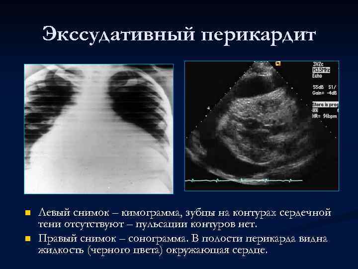 Экссудативный перикардит n n Левый снимок – кимограмма, зубцы на контурах сердечной тени отсутствуют