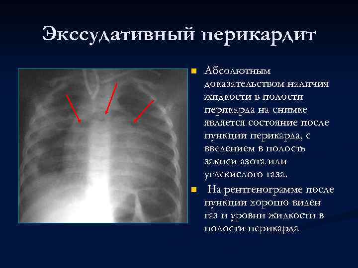 Экссудативный перикардит n n Абсолютным доказательством наличия жидкости в полости перикарда на снимке является