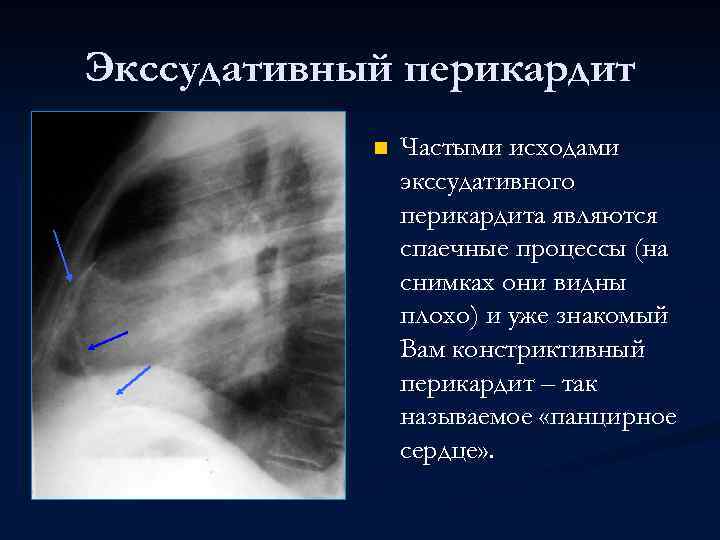 Экссудативный перикардит n Частыми исходами экссудативного перикардита являются спаечные процессы (на снимках они видны