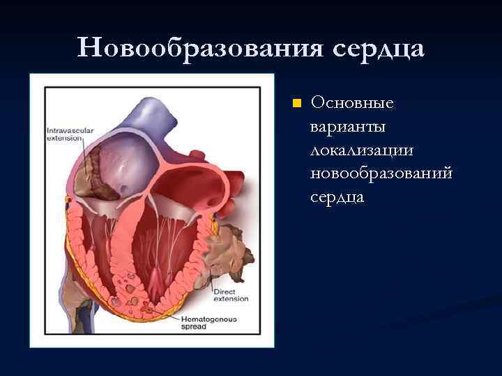 Новообразования сердца n Основные варианты локализации новообразований сердца 