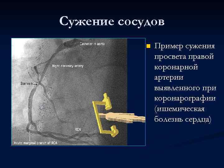 Сужение сосудов n Пример сужения просвета правой коронарной артерии выявленного при коронарографии (ишемическая болезнь