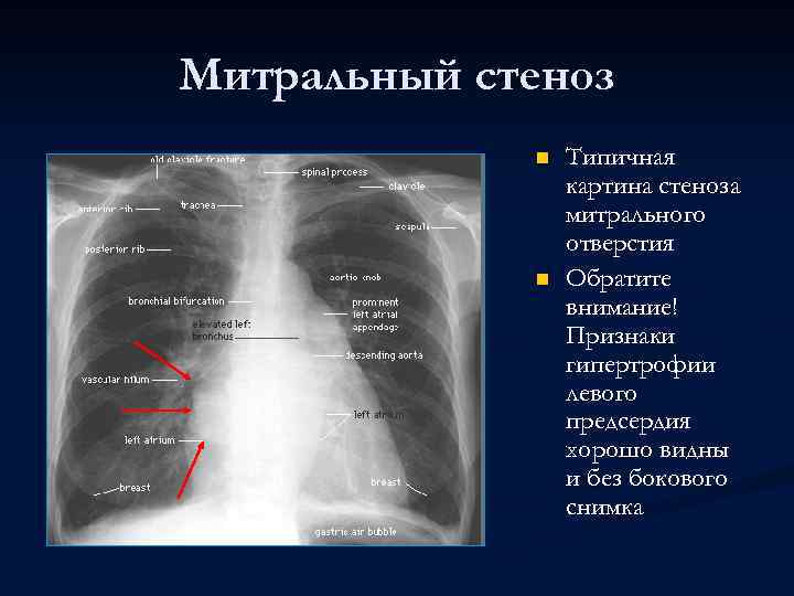 Митральный стеноз n n Типичная картина стеноза митрального отверстия Обратите внимание! Признаки гипертрофии левого