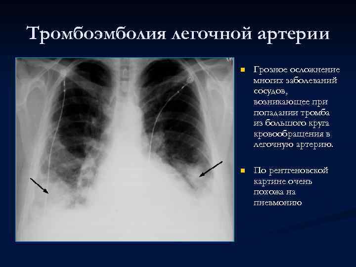 Тромбоэмболия легочной артерии n Грозное осложнение многих заболеваний сосудов, возникающее при попадании тромба из