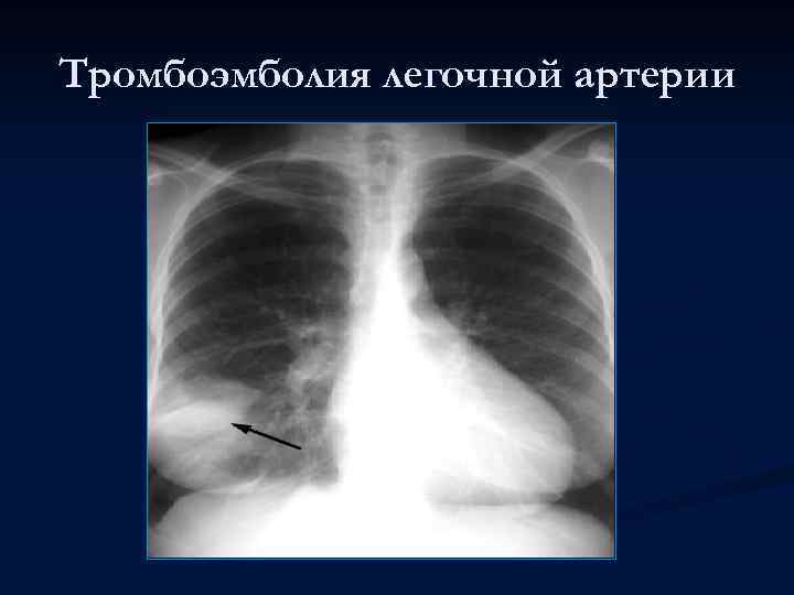 Тромбоэмболия легочной артерии 