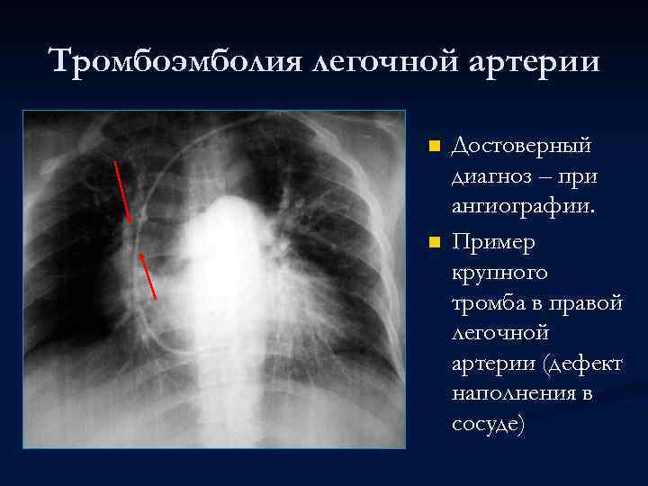 Тромбоэмболия легочной артерии n n Достоверный диагноз – при ангиографии. Пример крупного тромба в