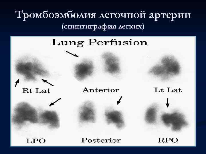 Тромбоэмболия легочной артерии (сцинтиграфия легких) 