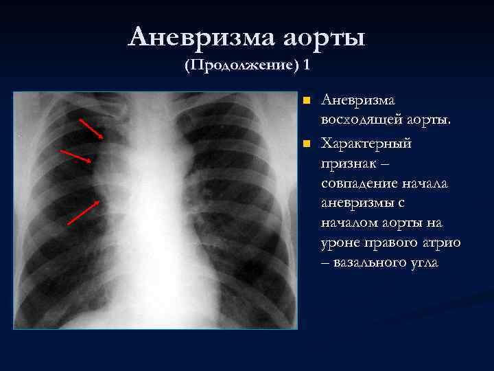 Аневризма аорты (Продолжение) 1 n n Аневризма восходящей аорты. Характерный признак – совпадение начала