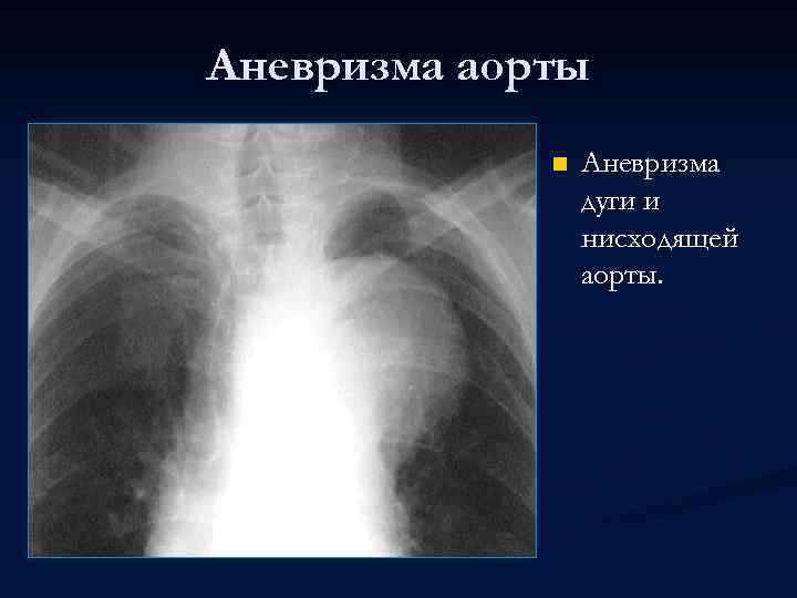 Аневризма аорты n Аневризма дуги и нисходящей аорты. 