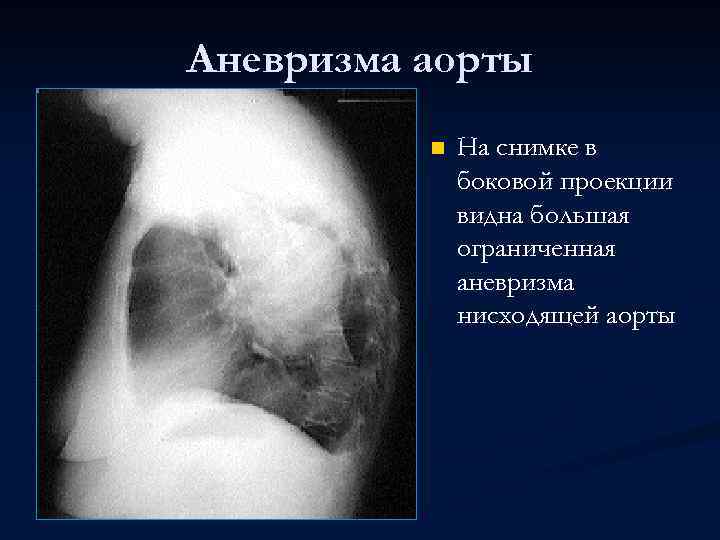 Аневризма аорты n На снимке в боковой проекции видна большая ограниченная аневризма нисходящей аорты