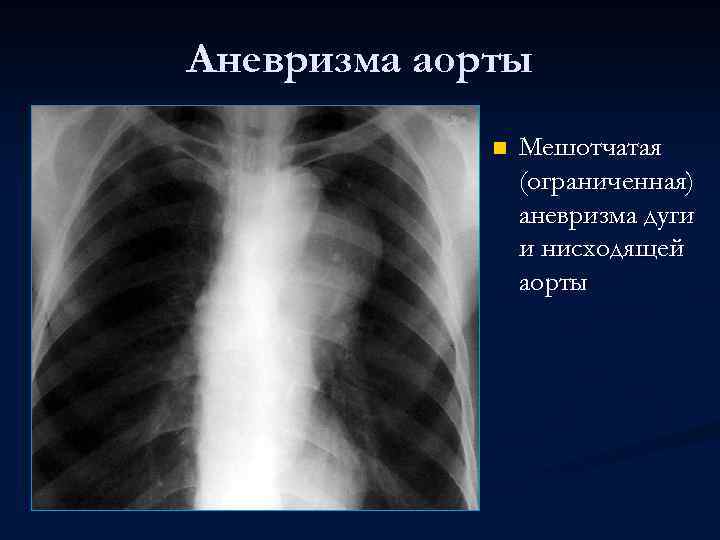 Аневризма аорты n Мешотчатая (ограниченная) аневризма дуги и нисходящей аорты 