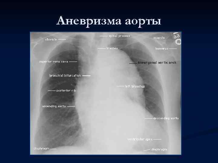 Аневризма аорты 