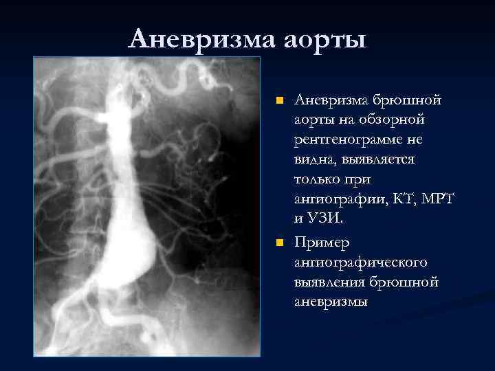 Аневризма аорты n n Аневризма брюшной аорты на обзорной рентгенограмме не видна, выявляется только