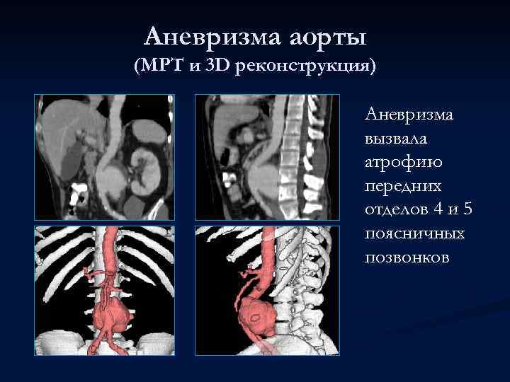 Аневризма аорты (МРТ и 3 D реконструкция) Аневризма вызвала атрофию передних отделов 4 и