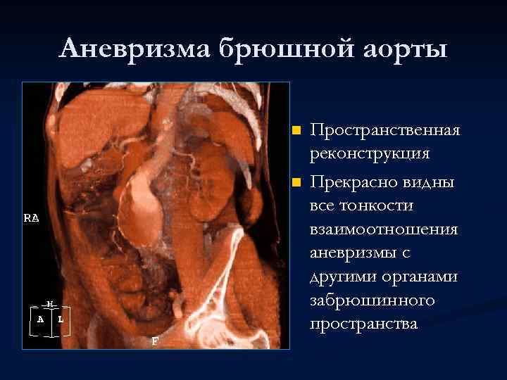 Аневризма брюшной аорты n n Пространственная реконструкция Прекрасно видны все тонкости взаимоотношения аневризмы с