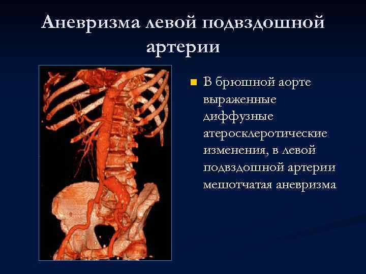 Аневризма левой подвздошной артерии n В брюшной аорте выраженные диффузные атеросклеротические изменения, в левой