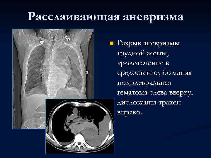 Расслаивающая аневризма n Разрыв аневризмы грудной аорты, кровотечение в средостение, большая подплевральная гематома слева