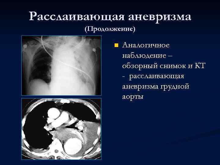 Расслаивающая аневризма (Продолжение) n Аналогичное наблюдение – обзорный снимок и КТ - расслаивающая аневризма