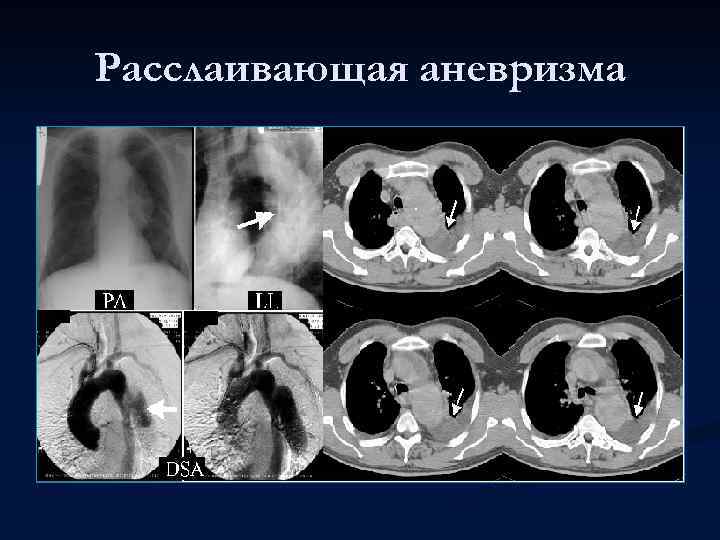 Расслаивающая аневризма 