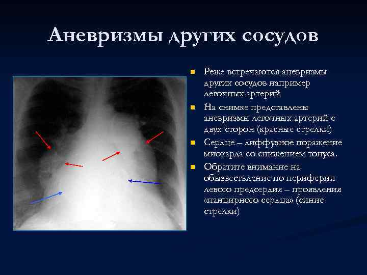 Аневризмы других сосудов n n Реже встречаются аневризмы других сосудов например легочных артерий На