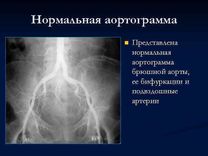 Нормальная аортограмма n Представлена нормальная аортограмма брюшной аорты, ее бифуркации и подвздошные артерии 