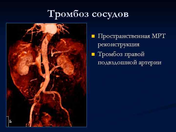 Тромбоз сосудов n n Пространственная МРТ реконструкция Тромбоз правой подвздошной артерии 