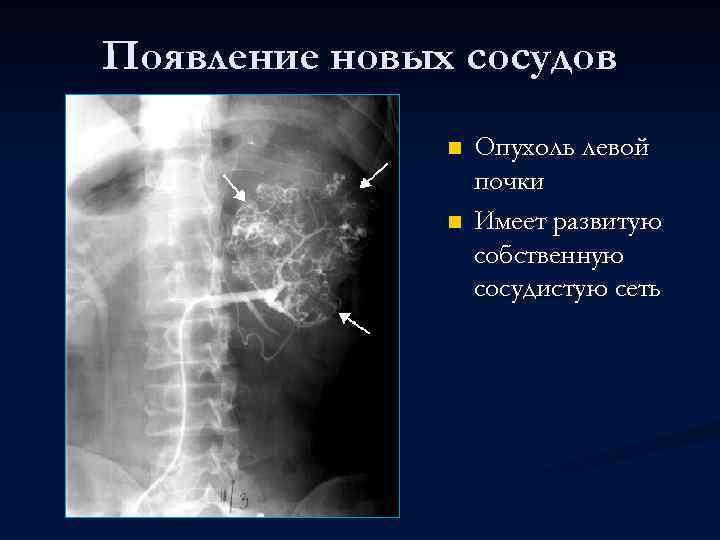 Появление новых сосудов n n Опухоль левой почки Имеет развитую собственную сосудистую сеть 